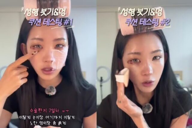 ‘故최진실 딸’ 최준희, 성형 부작용으로 ‘실명’…