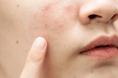 여드름 짜고싶어도 “이 부위”는 짜지 마세요, 안면마비 찾아옵니다.