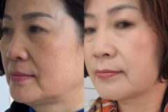 내돈내산 올타이트 리프팅으로 턱라인 처짐 개선한 후기 + 유지기간