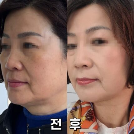 내돈내산 올타이트 리프팅으로 턱라인 처짐 개선한 후기 + 유지기간
