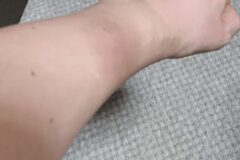혈액암이 찾아 오면 “이 증상”부터 나타납니다, 지금 당장 확인하세요.