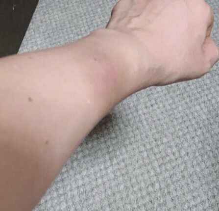 혈액암이 찾아 오면 “이 증상”부터 나타납니다, 지금 당장 확인하세요.