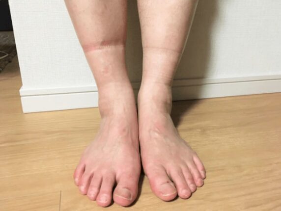 혈관이 썩기 시작하면 “다리에 이 증상”부터 찾아옵니다 당장 확인하세요.