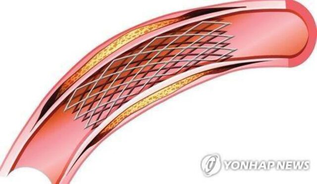 “당뇨병 환자, 스텐트 시술 합병증 위험 최대 2.28배”…맞춤 치료 필요