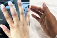 골절로 부은 줄… 증상 방치하다 ‘손가락 절단’한 여성 (+충격 이유)