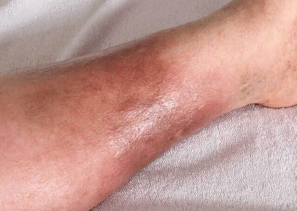 피부에 생기면 “3개월만에 사망하게 만든다는 이 증상” 당장 확인하세요.