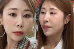 “갈비뼈 떼어 코에 심었다” 코미디언의 고백 이유?