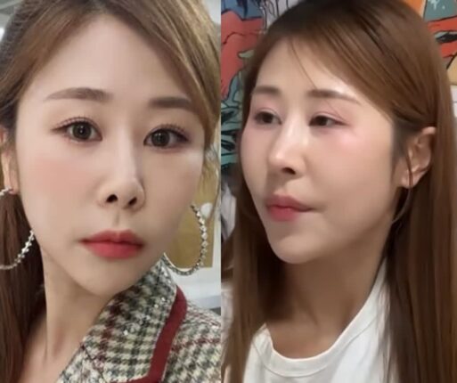 “갈비뼈 떼어 코에 심었다” 코미디언의 고백 이유?