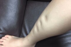발목에 갑자기 “이런 증상” 생겼다면 신장이 심각하게 망가진 겁니다.