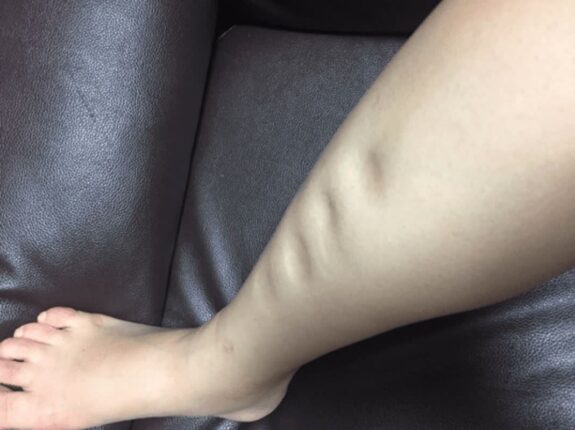 발목에 갑자기 “이런 증상” 생겼다면 신장이 심각하게 망가진 겁니다.