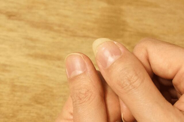 만약 손톱에 “이런 증상” 보인다면 혈액 속 단백질 전부 빠져나가는 겁니다.