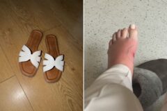 매장 진열 샌들 맨발에 신었다가… 박테리아 감염으로 ‘패혈증’ 위기까지